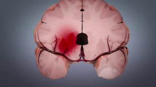 Shakeel Chowdhry, MD, discusses the difference between ischemic stroke and hemmoragic stroke and covers surgical and endovascular treatment options. 