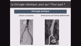 Stratégie de formation en chirurgie vasculaire robotique.