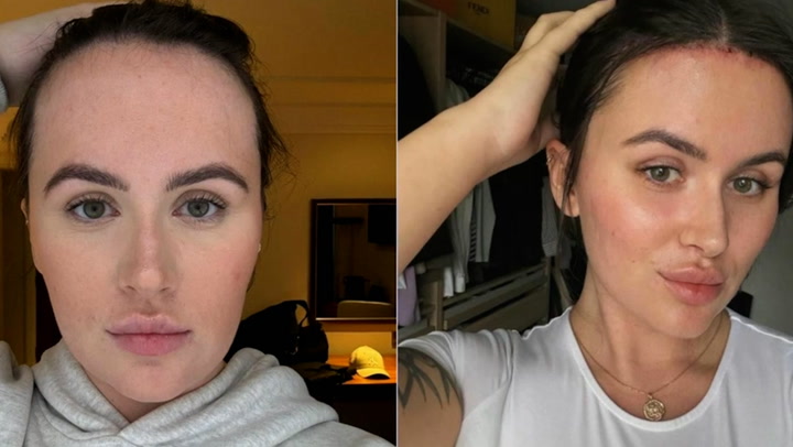 Woman who got £9,000 forehead reduction speaks out