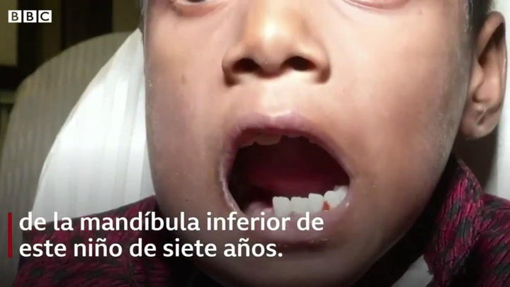 El extraño caso de un niño al que le extrajeron 526 dientes - Fuente: BBC