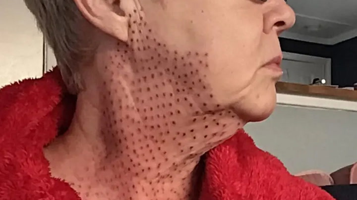 Woman left with 'lizard' neck after 'nightmare' procedure to fix double chin