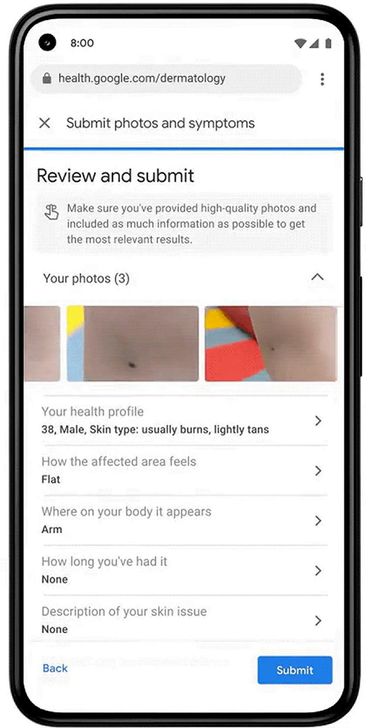 Google creó una herramienta para detectar cáncer de piel