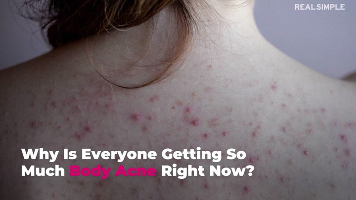 5 Causes of Body Acne and How to Get Rid of It