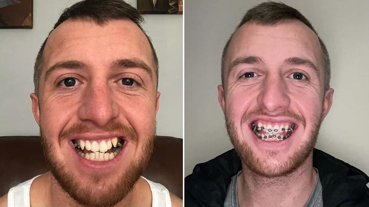 'I chose braces in my 30s over 'Turkey teeth' - trolls don't bother me'