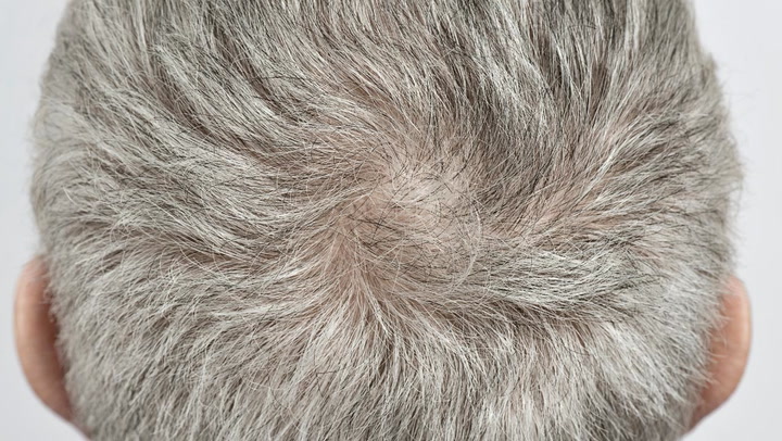 How to Stop Hair Loss: Why Is My Hair Falling Out? | Time
