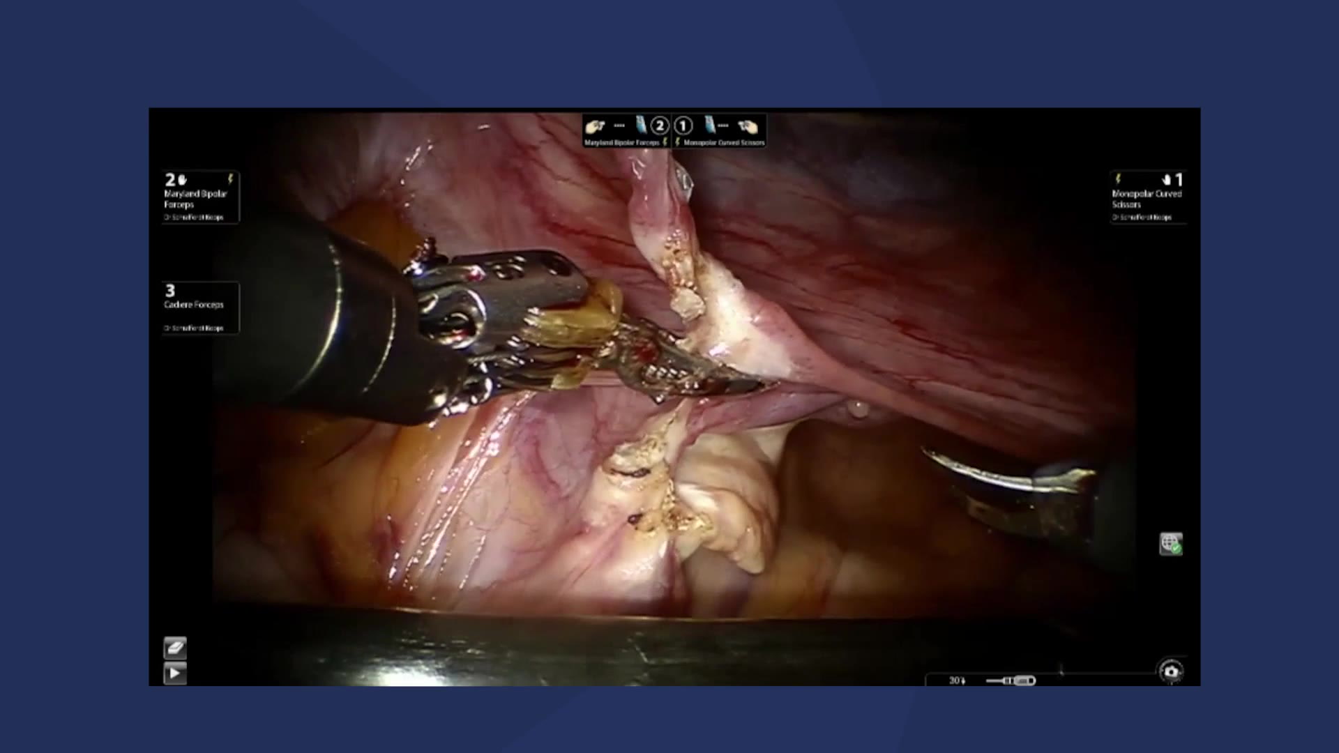 Robot-assisted supravaginal hysterectomy and ventral rectopexy with cervicopexy