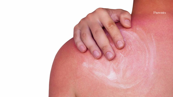 12 Best Home Remedies for Sunburn - How to Get Rid of Skin Burn