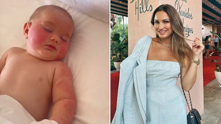 Sam Faiers opens up on how she 'cured' baby boy's severe eczema with natural products