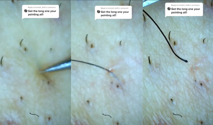 Ingrown hair 'size of a golf club' pulled out of infected pore in  satisfying video - Daily Star