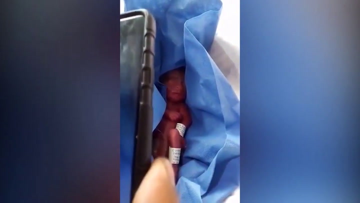 Dieron por muerto a un bebé prematuro y su padre descubrió que estaba vivo
