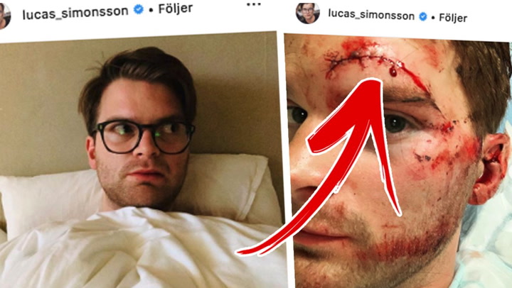 Komikern Lucas Simonssons otäcka skada efter dramatiska olyckan med elsparkcykeln