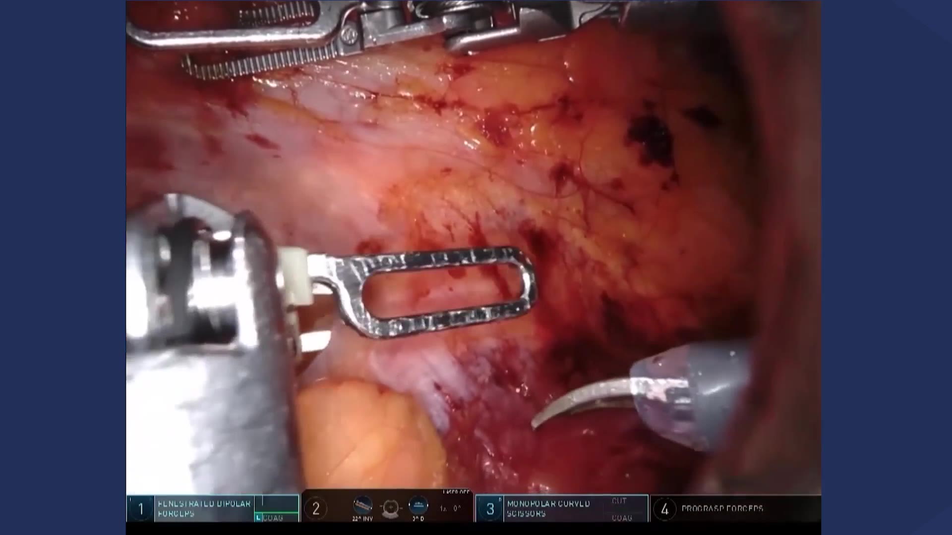 Robot-assisted left retroperitoneal partial nephrectomy (RAPN)