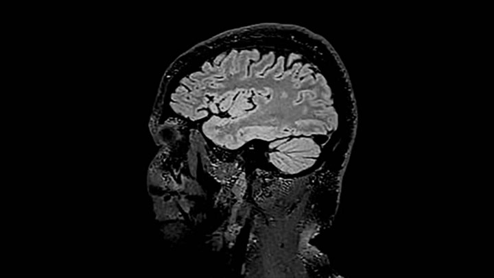 Un estudio encuentra cambios en el cerebro de quienes tuvieron COVID-19