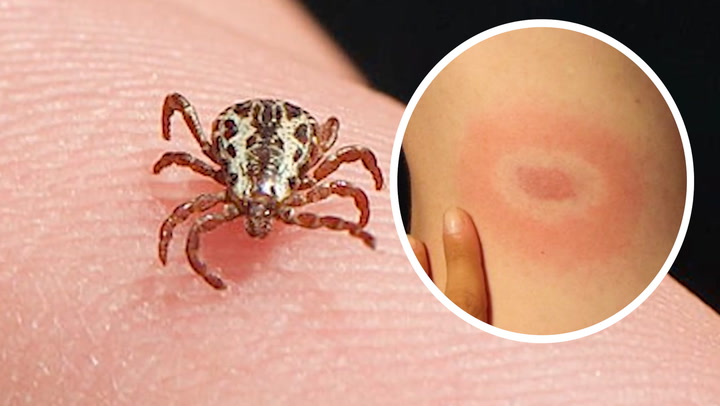 TICK BITES: WHAT TO DO IF YOU SUSPECT YOU'VE BEEN BITTEN