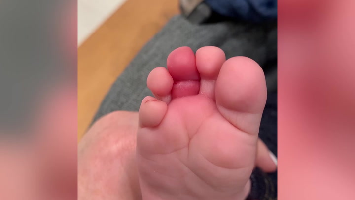 Five-moth-old baby’s toe swells and turns purple after hair wraps around it