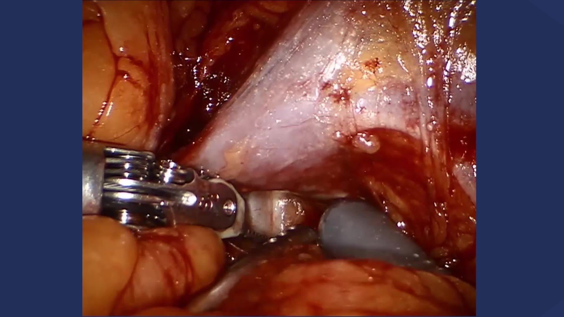 Robot-assisted left-sided transperitoneal partial nephrectomy (RAPN)