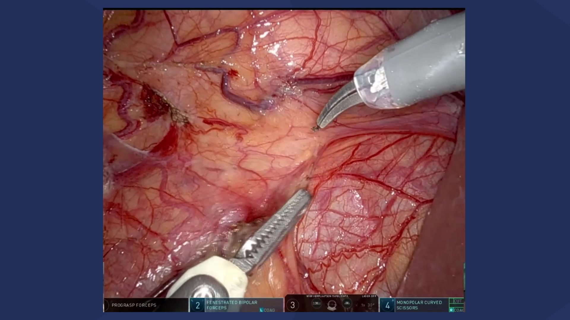 Robot-assisted right-sided radical nephro-ureterectomy