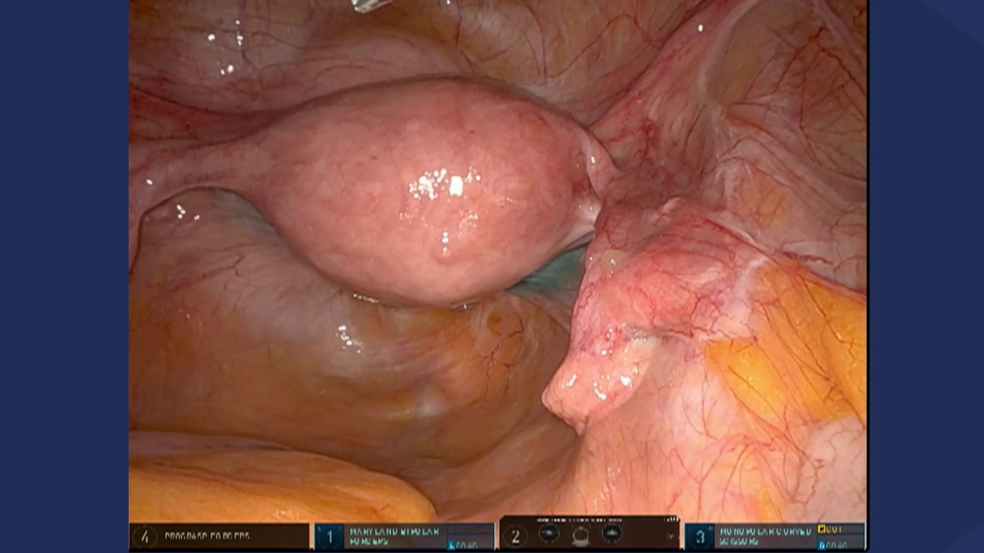 Robot-assisted simple hysterectomy, salpingo-oophorectomy and sentinel endometrial cancer
