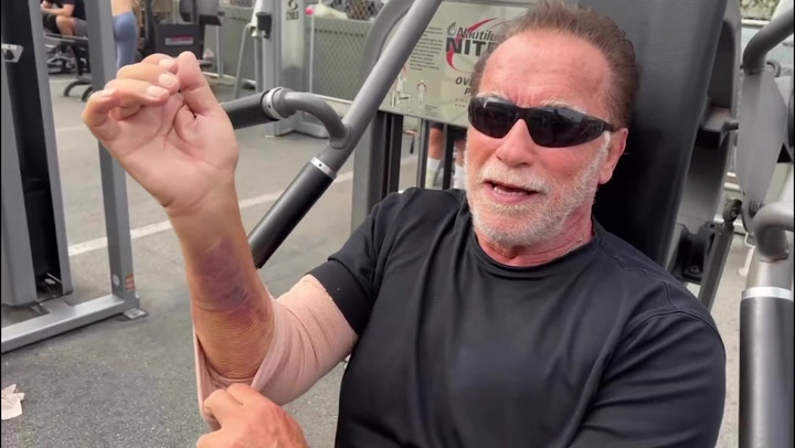 Arnold Schwarzenegger works out with badly bruised arm while recovering from surgery