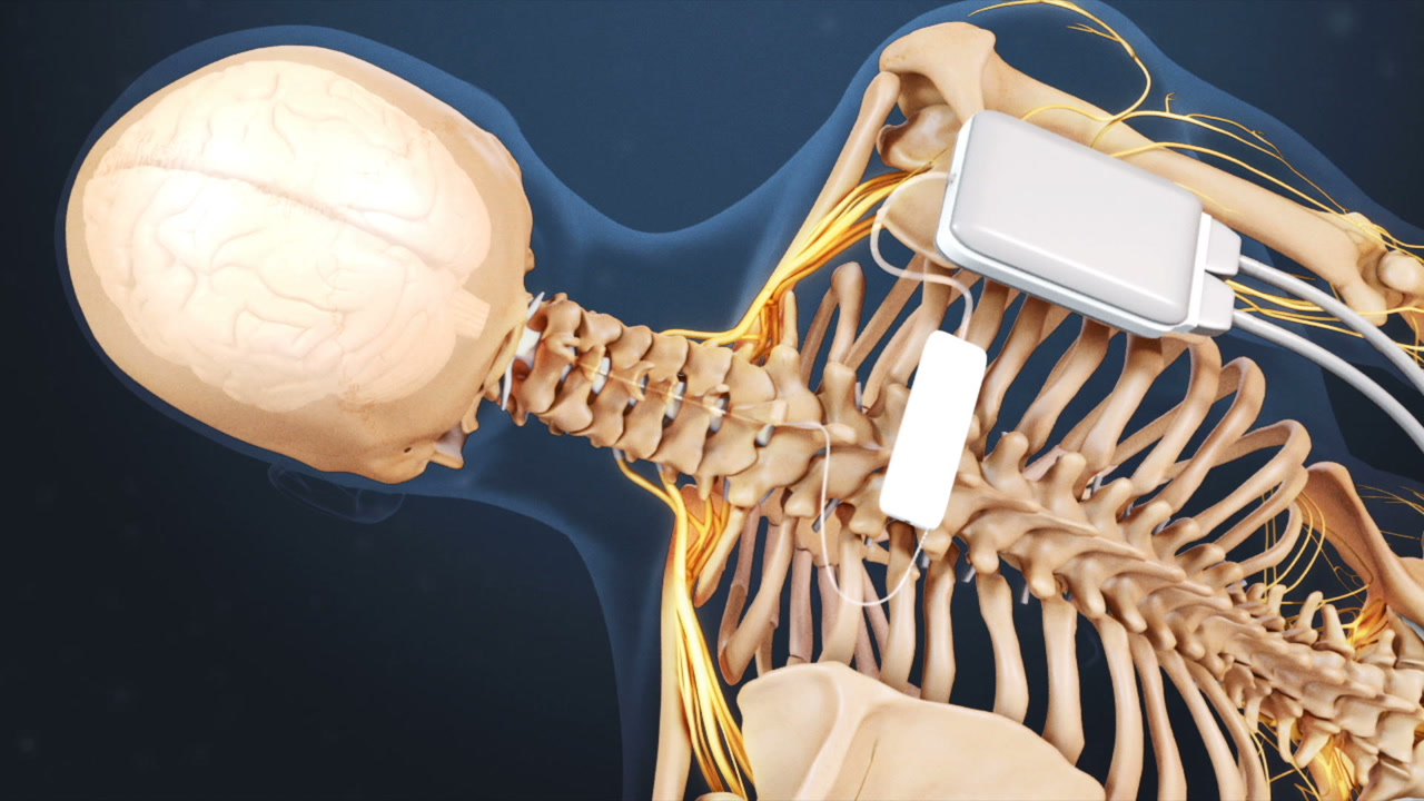 Spinal Cord Stimulation - Pain pacemaker