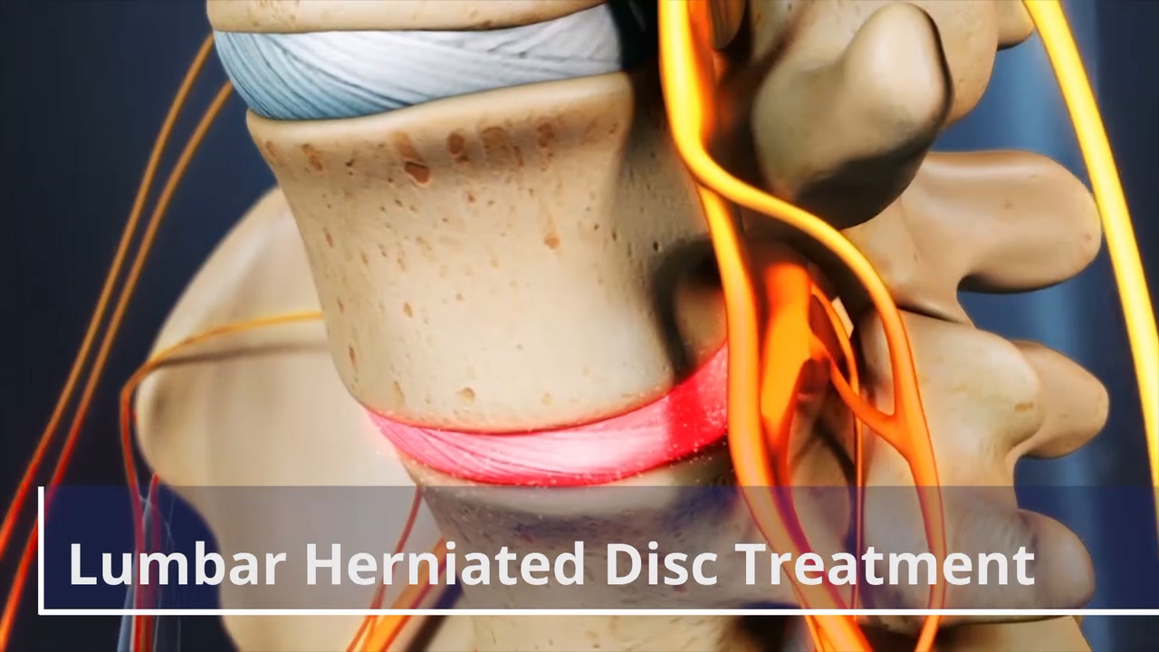Diagnosing a Lumbar Herniated Disc