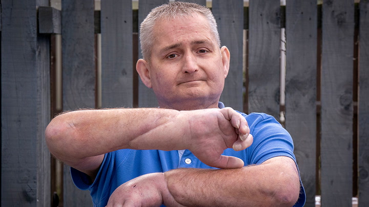 Man receives double hand transplant in ‘world first’ for scleroderma patients