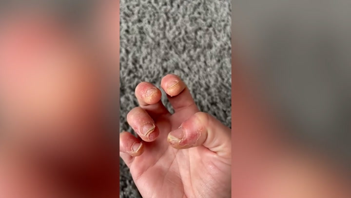 Mother 'can barely move her hands' after years of gel nails