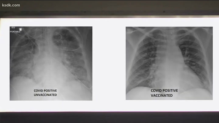 X-rays show difference of Covid's effect on vaccinated and unvaccinated patients