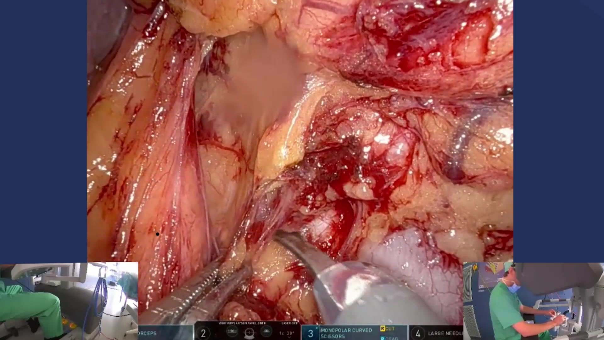 Robot-assisted transperitoneal, left-sided partial nephrectomy (RAPN)