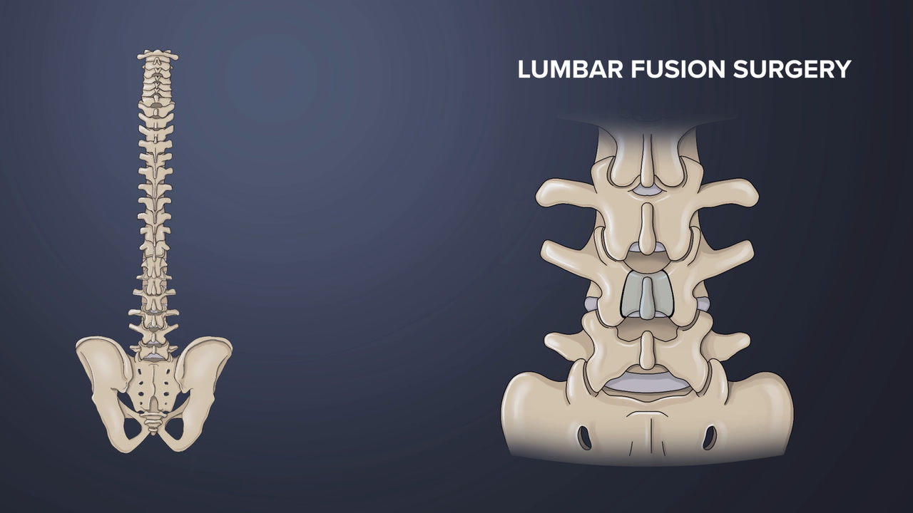 Spinal fusion - Mayo Clinic