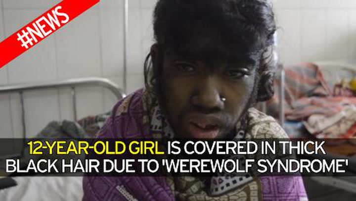 Werewolf' girl covered in thick black hair due to rare condition lives  'like a recluse' to avoid bullies - Irish Mirror Online