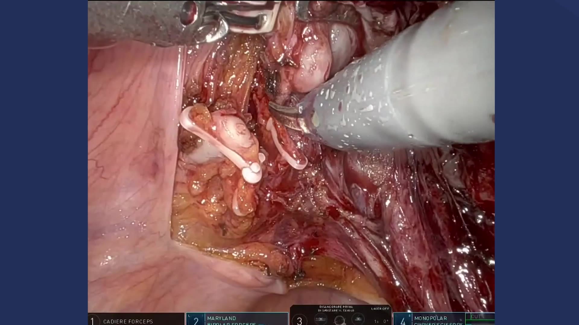 Robot-assisted radical prostatectomy (RARP) with PSMA radio guided surgery during PLND