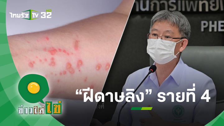 ด่วน! พบหญิงไทย ป่วย "ฝีดาษลิง" รายที่ 2 กทม. นับเป็นรายที่ 4 ของไทย l ข่าวใส่ไข่