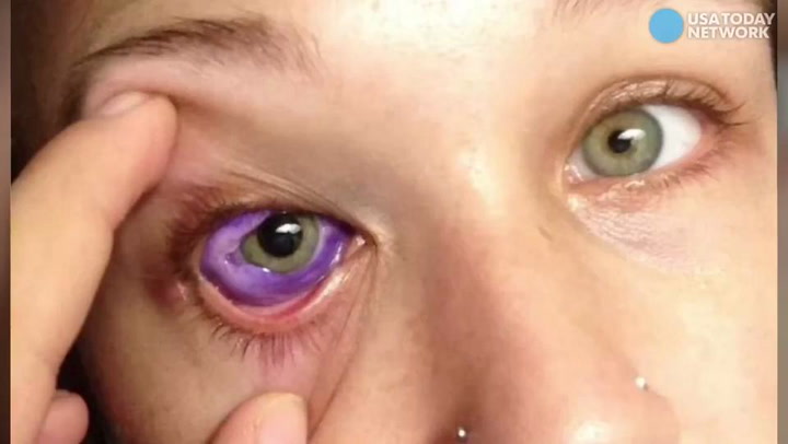 Woman Losing Sight Due to Eyeball Tattoos Has No Regrets